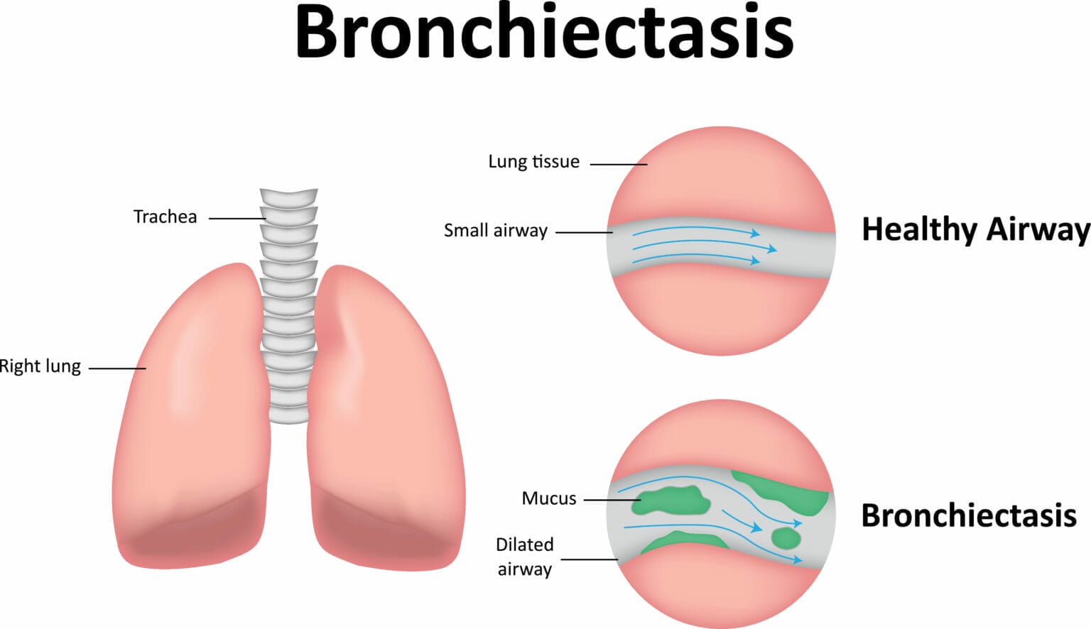 Bronchiectasis - Bronchiectactis Treatment London | Respiratory London