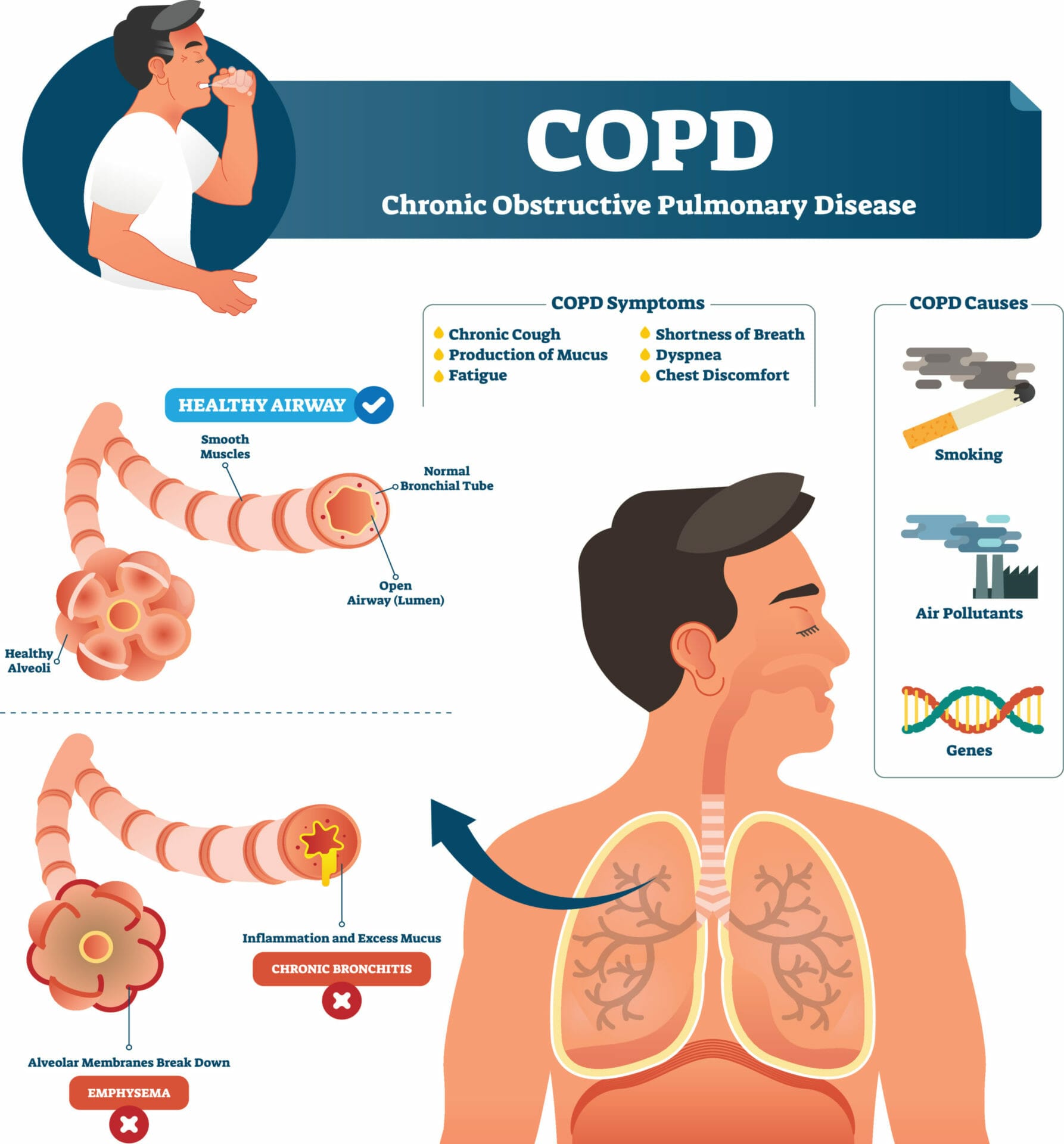 chronic obstructive pulmonary disease causes
