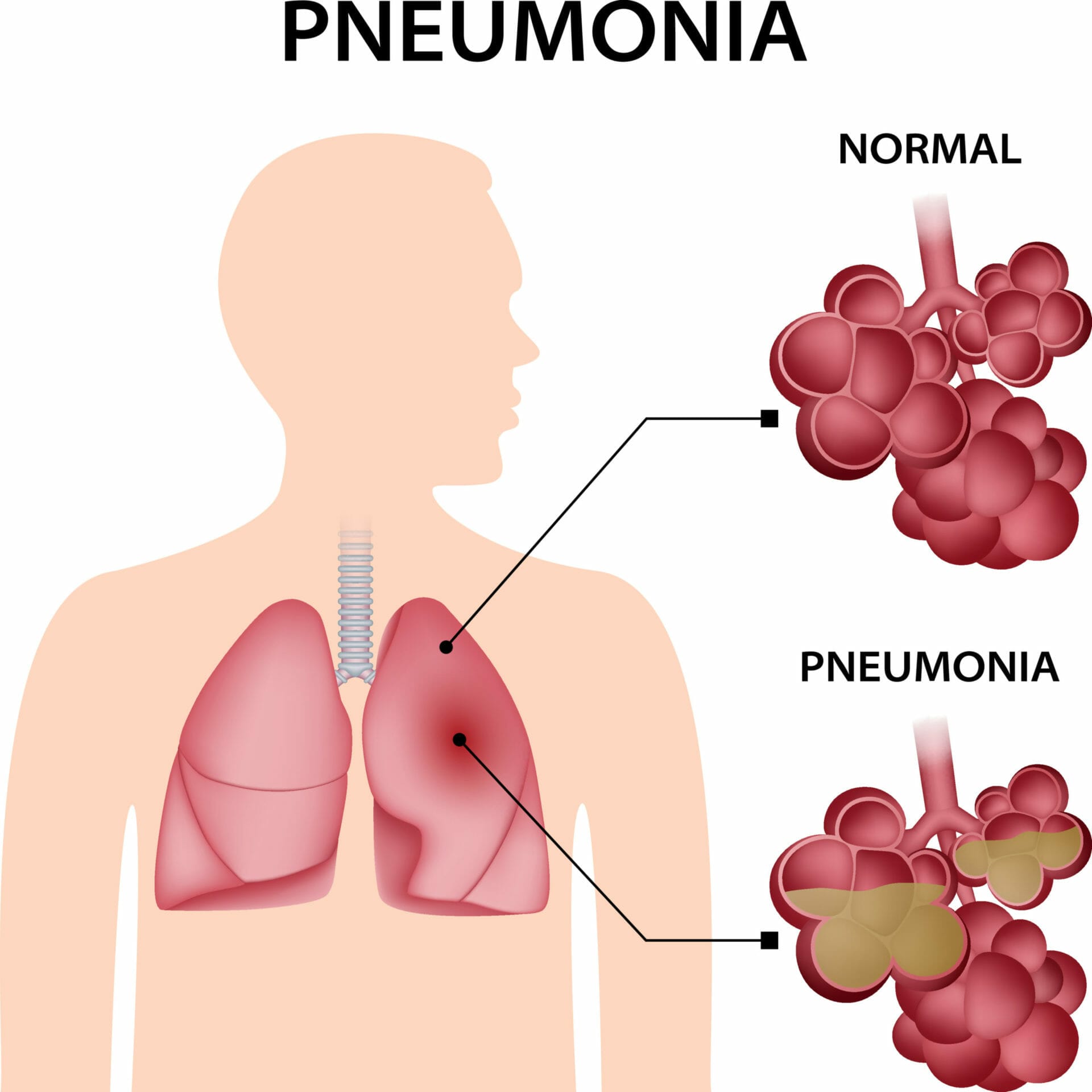 Pneumonia infographic