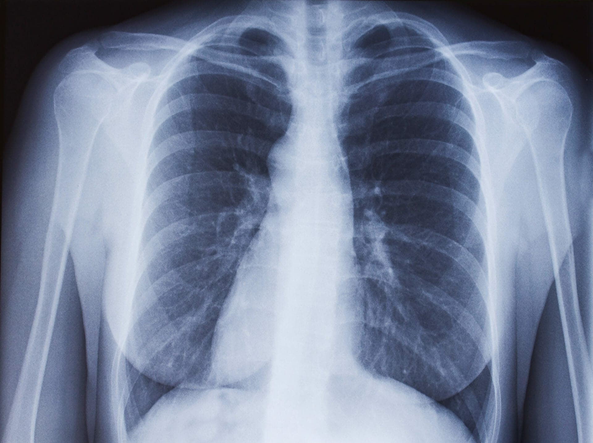 Chest x-ray, lungs infection, pulmorany disease, covid-19 new coronavirus illustration