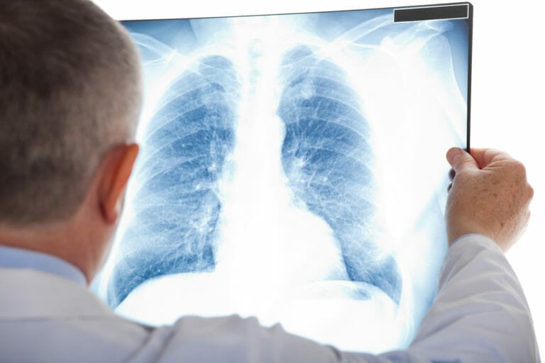 Lung Nodules | Pulmonary Nodules | Respiratory London