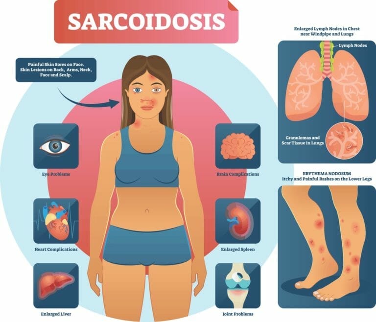 Sarcoidosis Private Sarcoidosis Treatment Respiratory London